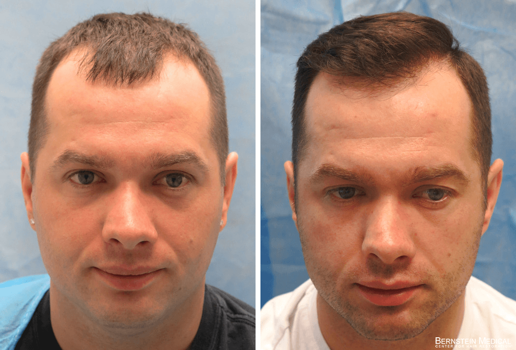 Bernstein Medical - Patient KZK Before and After Hair Transplant Photo 