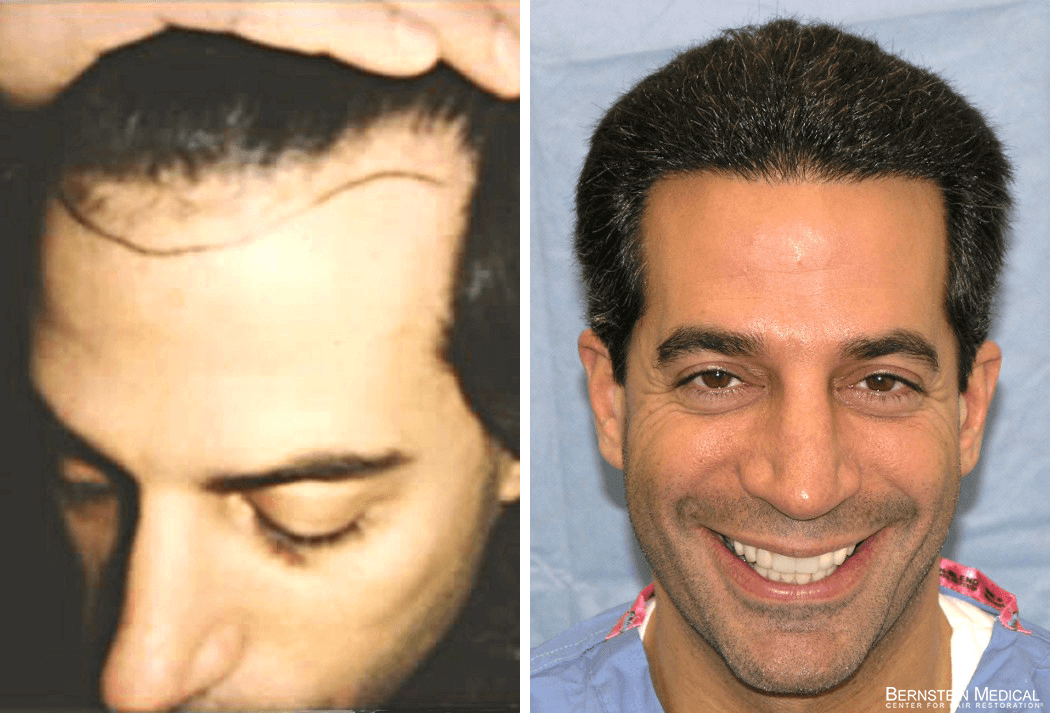 Bernstein Medical - Patient ABI Before and After Hair Transplant Photo 