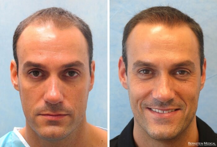 Bernstein Medical - Patient ACB Before and After Hair Transplant Photo 