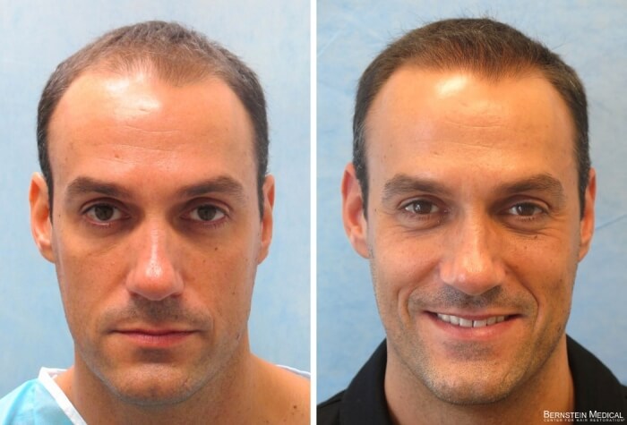 Bernstein Medical - Patient ACB Before and After Hair Transplant Photo
