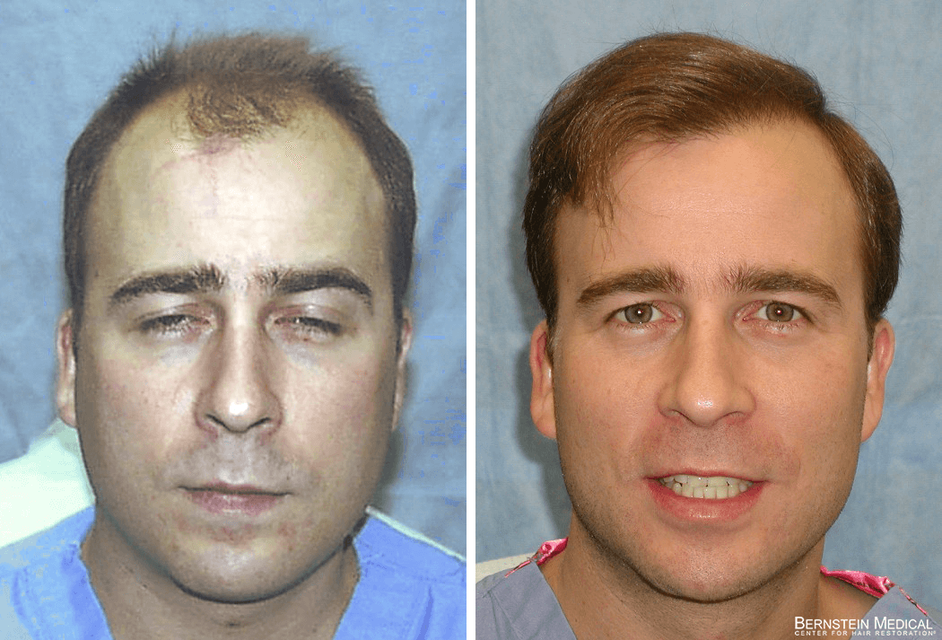 Bernstein Medical - Patient ACZ – Portrait Before and After Hair Transplant Photo 
