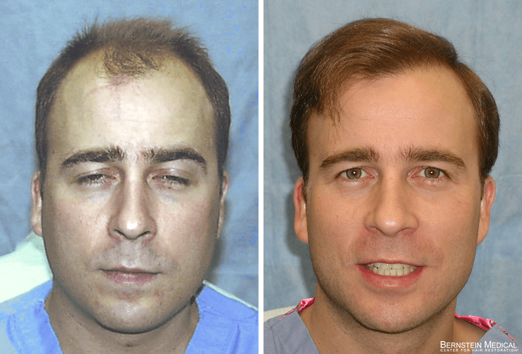 Bernstein Medical - Patient ACZ – Portrait Before and After Hair Transplant Photo