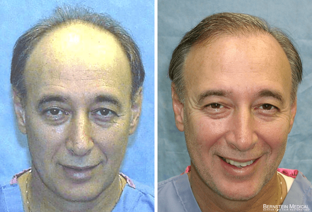 Bernstein Medical - Patient ADO Before and After Hair Transplant Photo