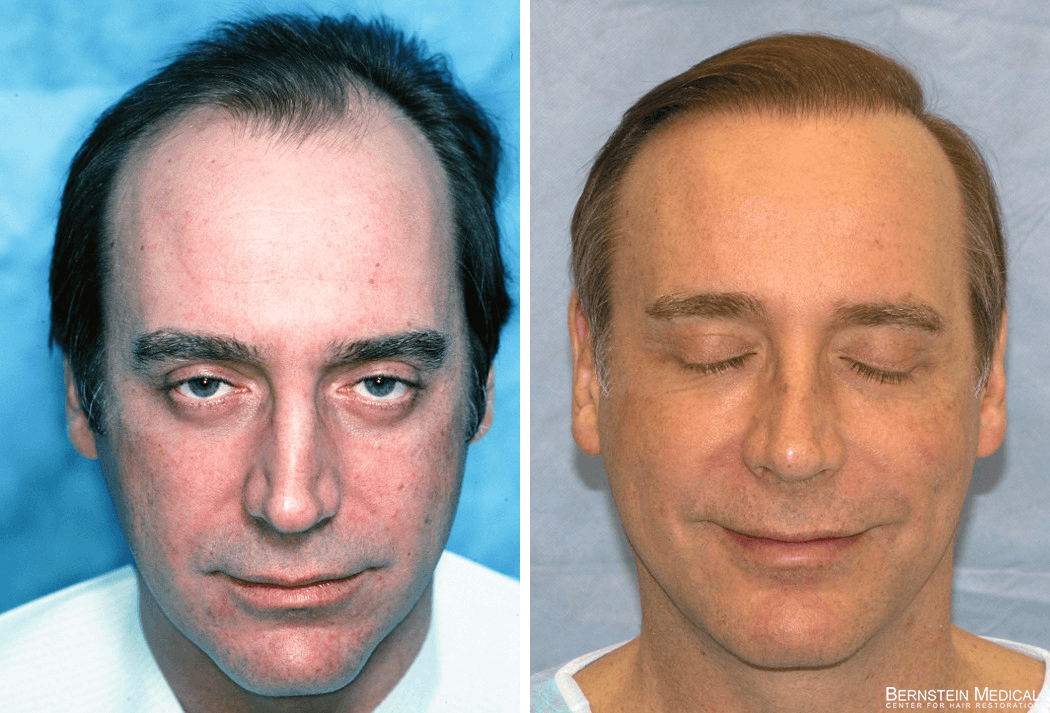 Bernstein Medical - Patient AHB Before and After Hair Transplant Photo 