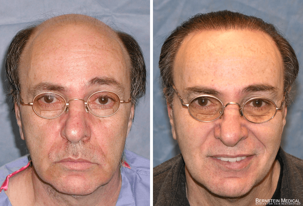 Bernstein Medical - Patient AJI Before and After Hair Transplant Photo 