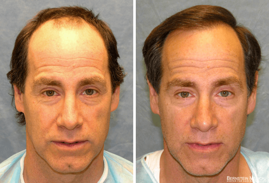 Bernstein Medical - Patient AKL Before and After Hair Transplant Photo 