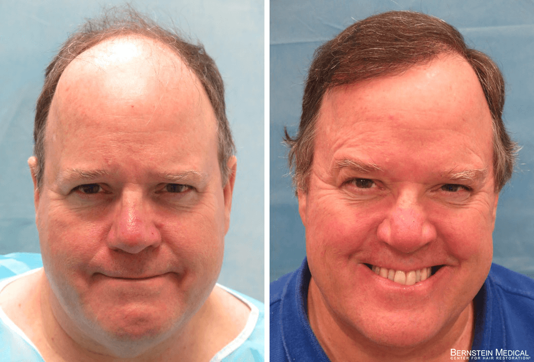 Bernstein Medical - Patient ALI Before and After Hair Transplant Photo 