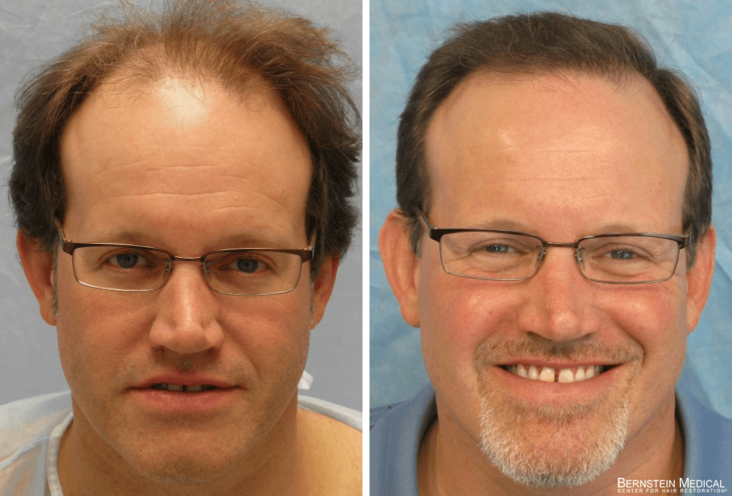 Bernstein Medical - Patient ANI Before and After Hair Transplant Photo 