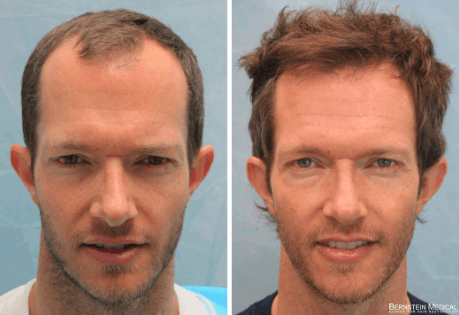 Hair Transplant Photos