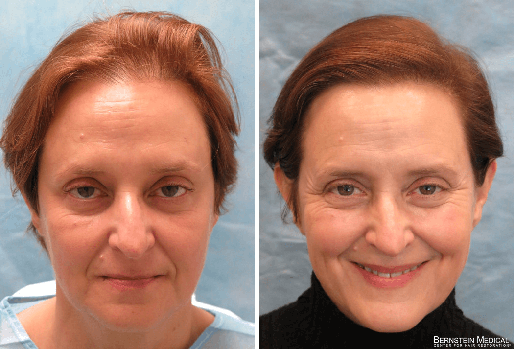 Hair Transplant NYC | Hair Restoration New York Hair Transplant NYC | Hair Restoration New York