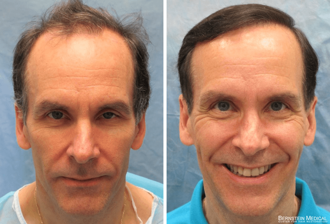 Bernstein Medical - Patient APL Before and After Hair Transplant Photo 
