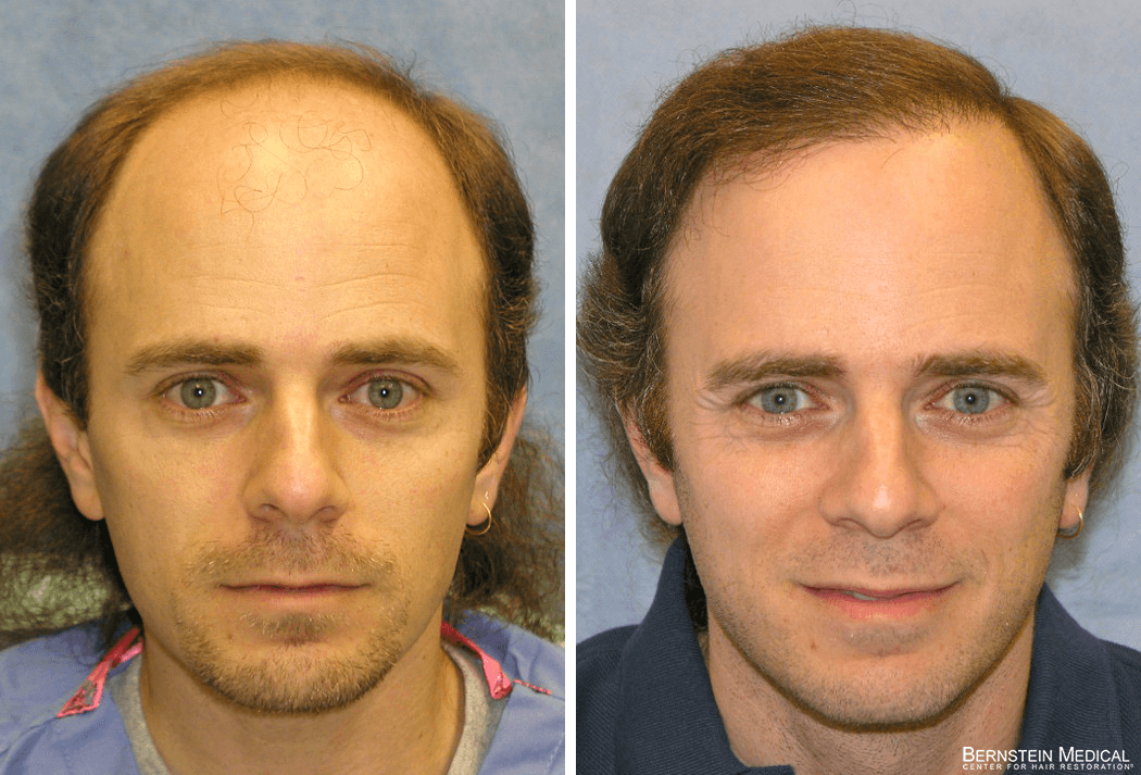 Bernstein Medical - Patient ATF Before and After Hair Transplant Photo 