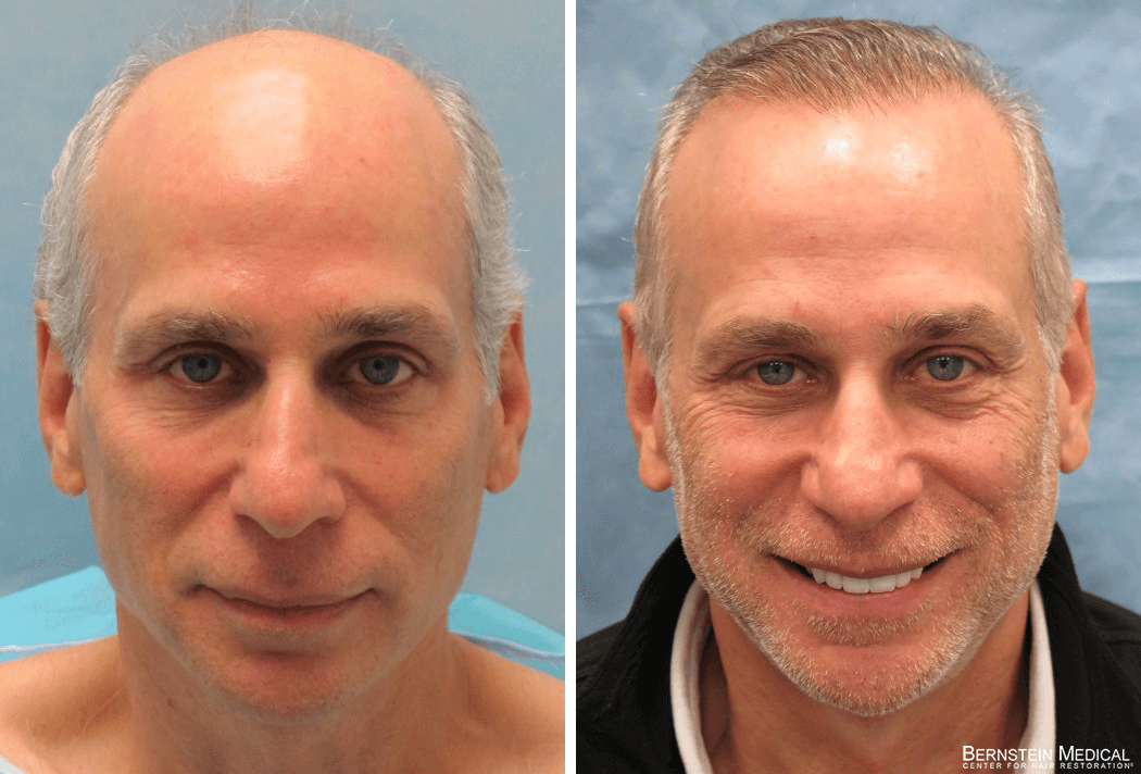 Bernstein Medical - Patient AVZ Before and After Hair Transplant Photo 