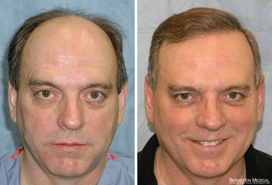 Bernstein Medical - Patient BEI Before and After Hair Transplant Photo 