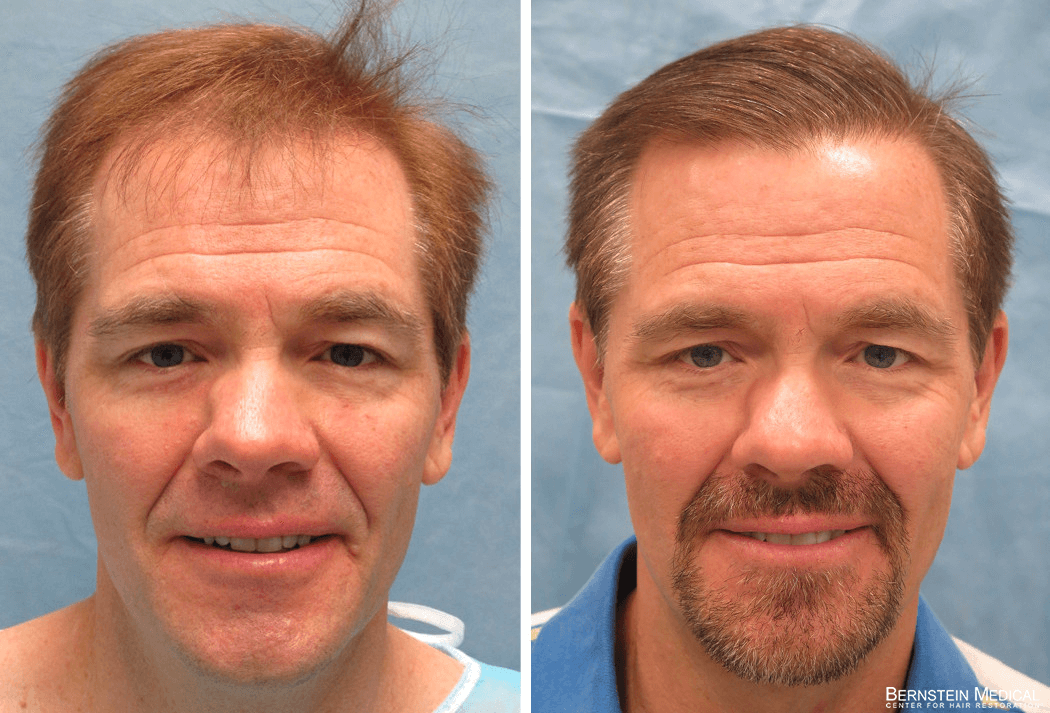Bernstein Medical - Patient BEO Before and After Hair Transplant Photo 