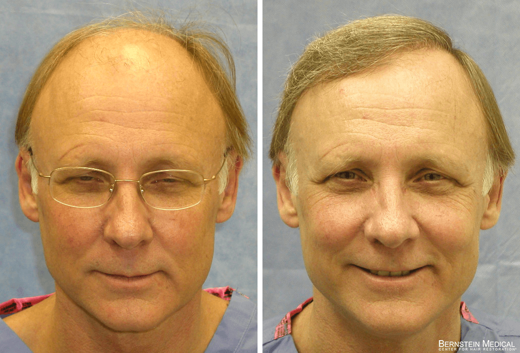 Bernstein Medical - Patient BFG Before and After Hair Transplant Photo 
