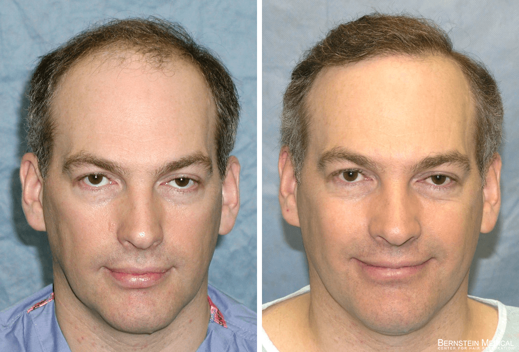 Bernstein Medical - Patient BGI Before and After Hair Transplant Photo 