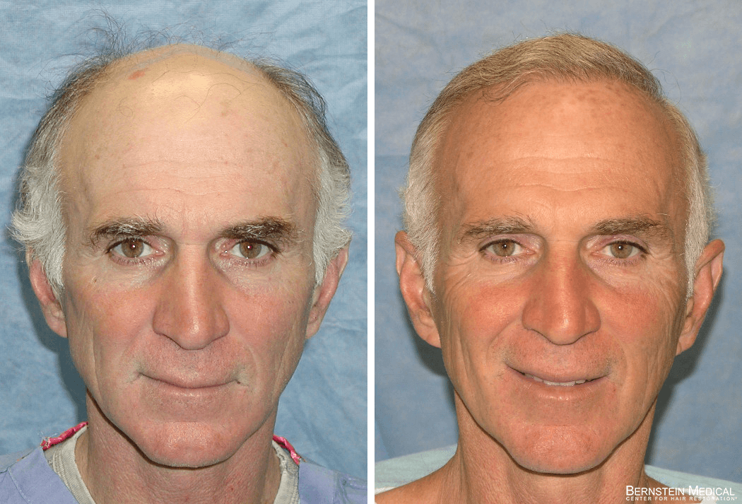 Bernstein Medical - Patient BHZ Before and After Hair Transplant Photo 