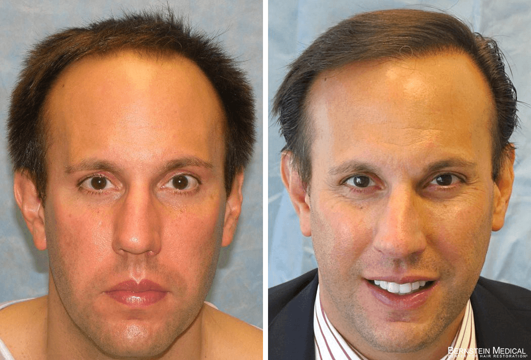 Bernstein Medical - Patient BKU Before and After Hair Transplant Photo 