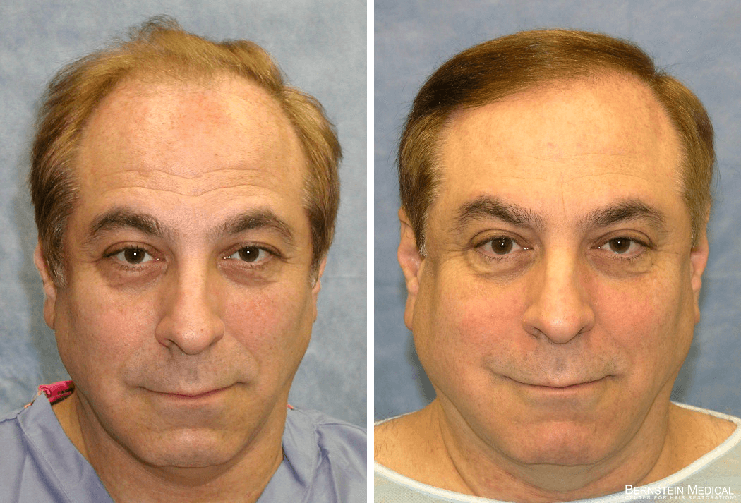 Bernstein Medical - Patient BLF Before and After Hair Transplant Photo 