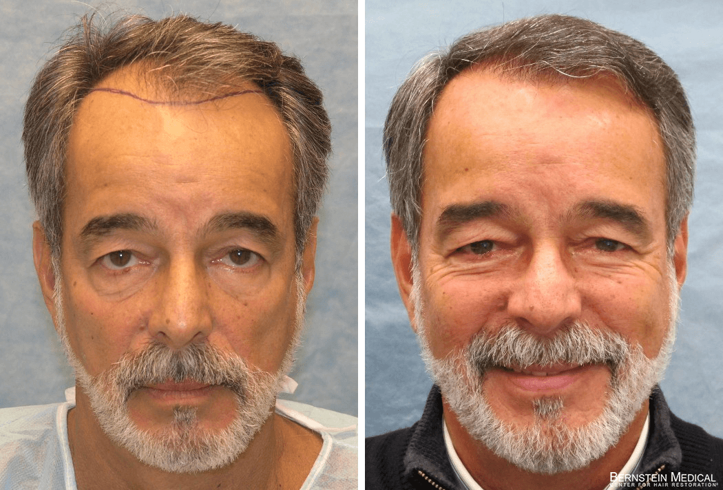 Bernstein Medical - Patient BPO Before and After Hair Transplant Photo 