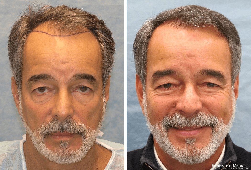 Bernstein Medical - Patient BPO Before and After Hair Transplant Photo