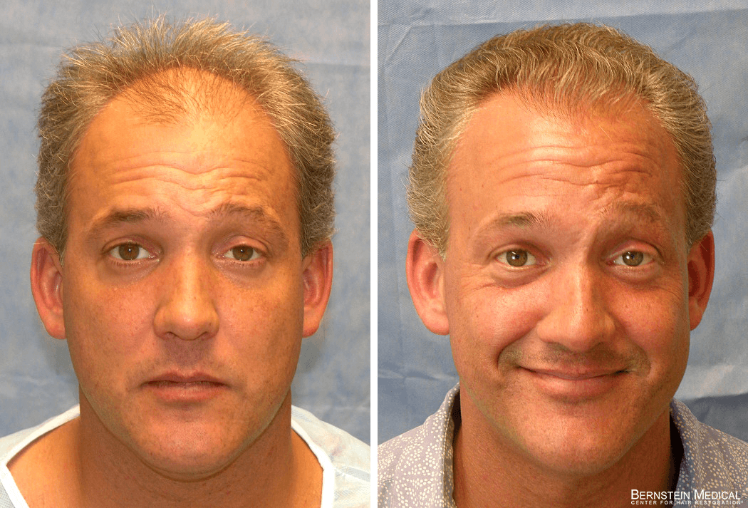 Bernstein Medical - Patient BRB Before and After Hair Transplant Photo