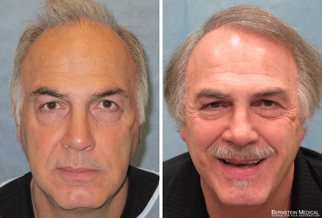 Bernstein Medical - Patient BRE Before and After Hair Transplant Photo 