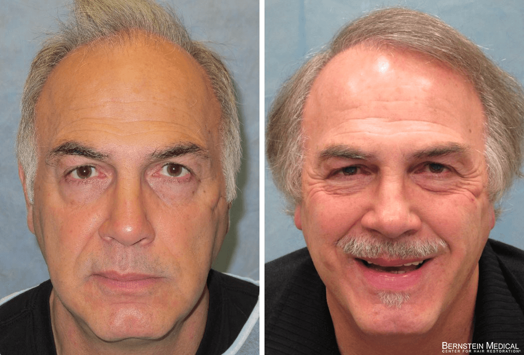 Bernstein Medical - Patient BRE Before and After Hair Transplant Photo