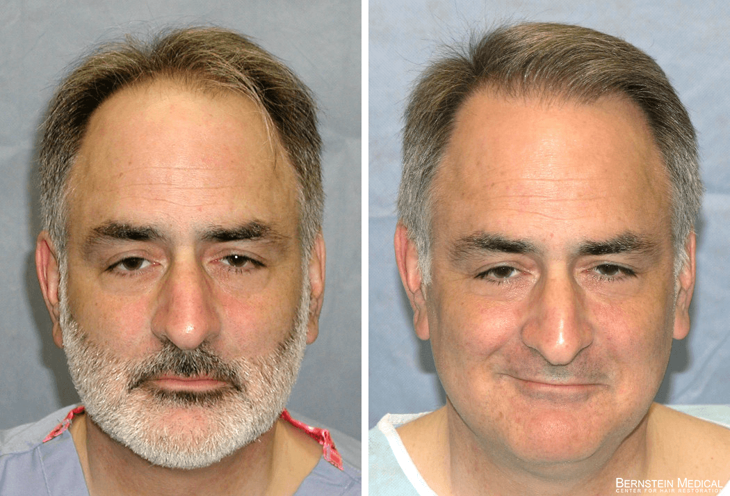 Bernstein Medical - Patient BSI Before and After Hair Transplant Photo 