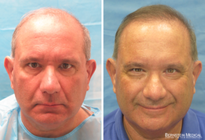 Before Hair Transplant - Patient BZB