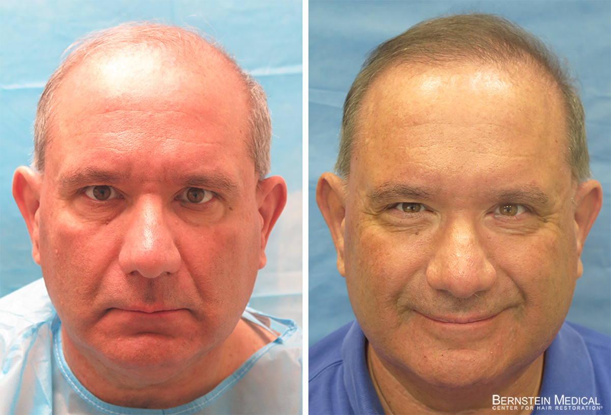 Bernstein Medical - Patient BZB Before and After Hair Transplant Photo 