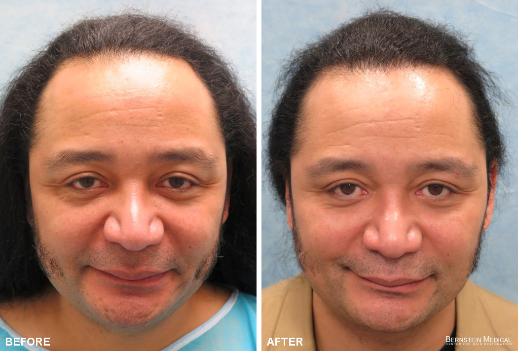 Bernstein Medical - Patient CEF Before and After Hair Transplant Photo 