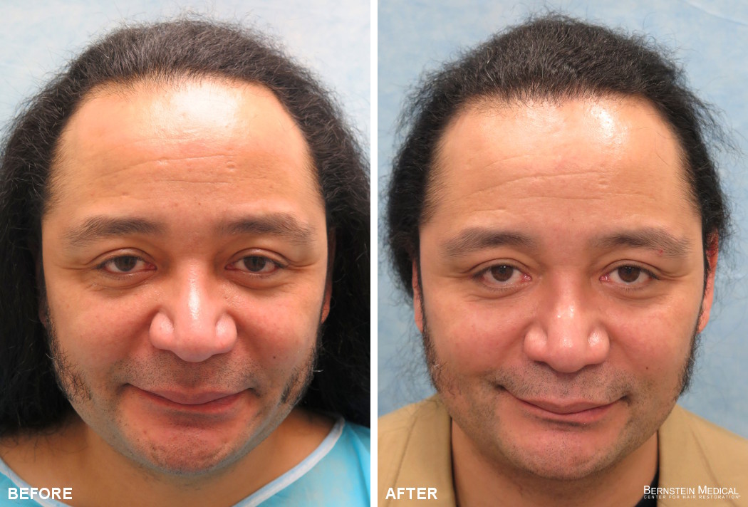 Bernstein Medical - Patient CEF Before and After Hair Transplant Photo