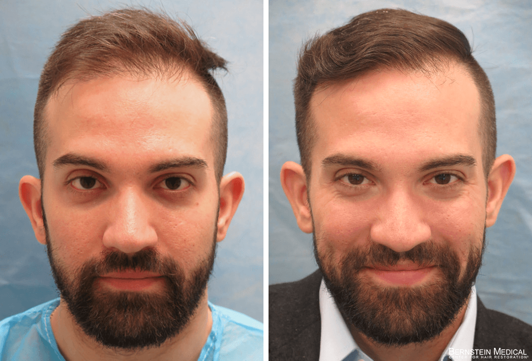 Bernstein Medical - Patient CFQ Portrait Before and After Hair Transplant Photo 