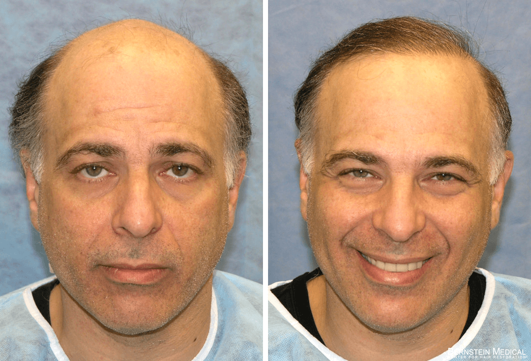 Bernstein Medical - Patient CHS Before and After Hair Transplant Photo