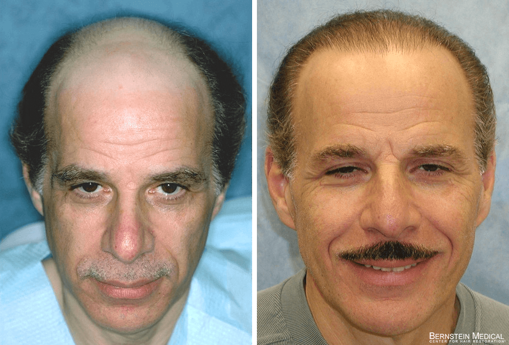 Bernstein Medical - Patient CIK Before and After Hair Transplant Photo 