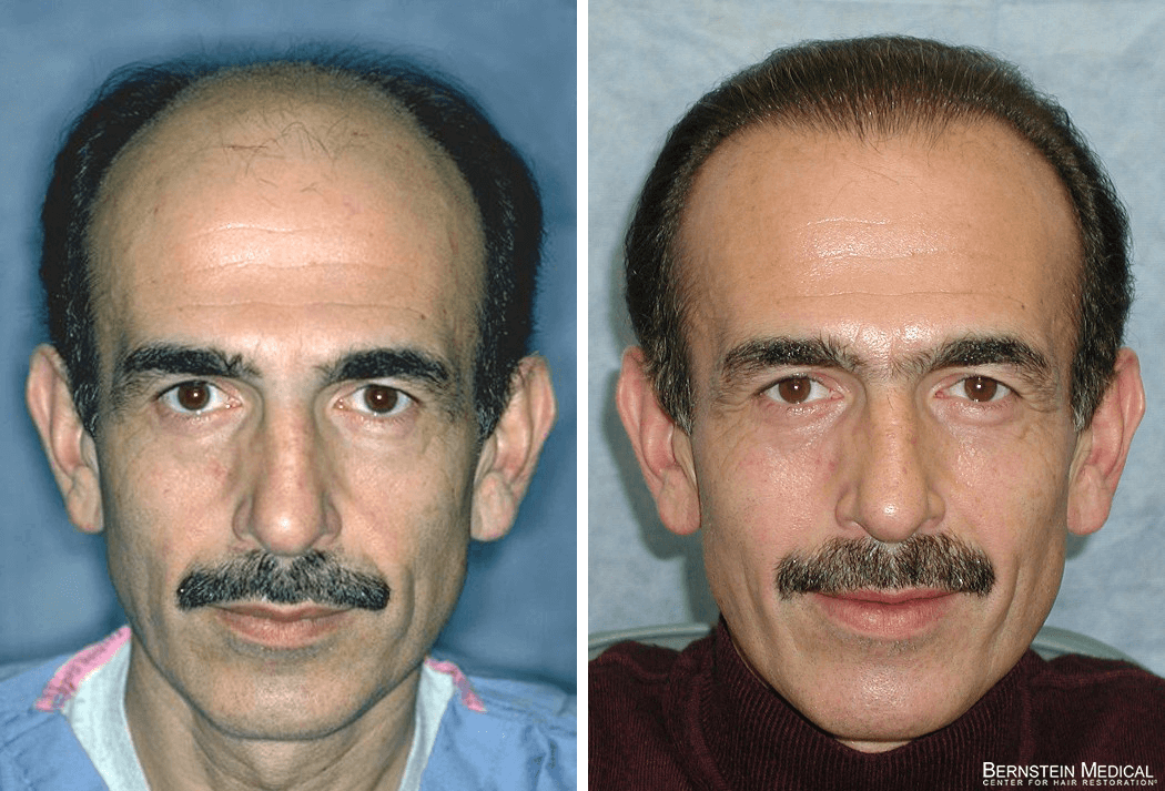 Bernstein Medical - Patient CJD Before and After Hair Transplant Photo 