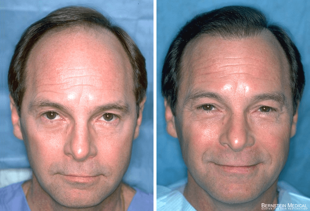 Bernstein Medical - Patient CKC Before and After Hair Transplant Photo 