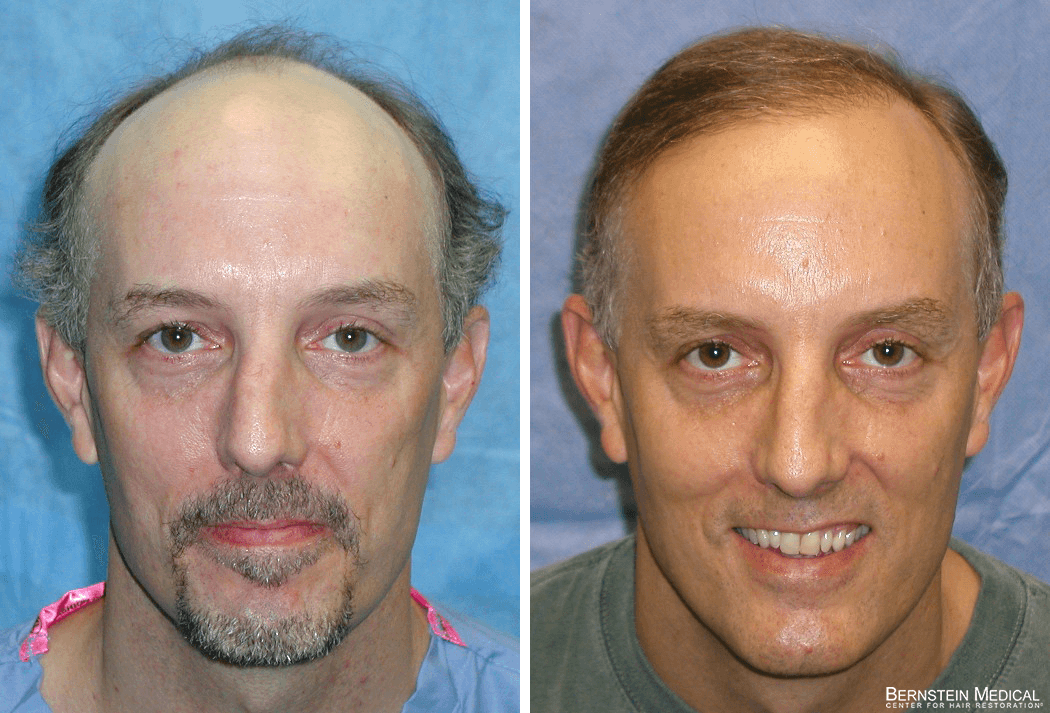 Bernstein Medical - Patient CMO Before and After Hair Transplant Photo 