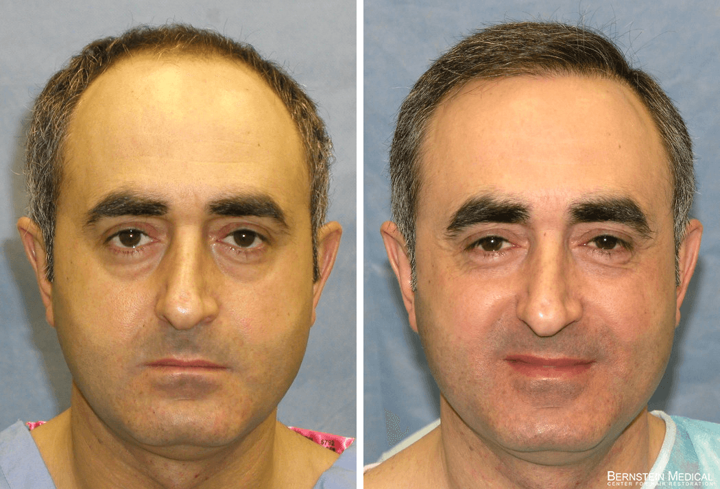 Bernstein Medical - Patient CSZ Before and After Hair Transplant Photo 