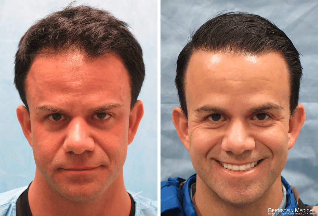 Bernstein Medical - Patient CTC Before and After Hair Transplant Photo 