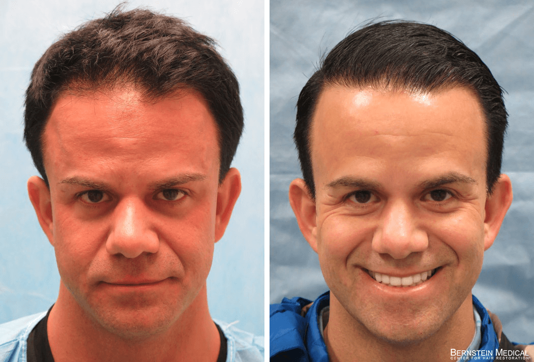 Bernstein Medical - Patient CTC Before and After Hair Transplant Photo