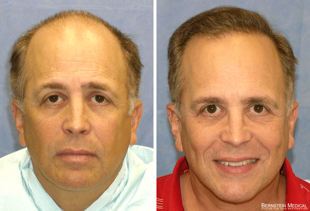 Bernstein Medical - Patient DVL Before and After Hair Transplant Photo 