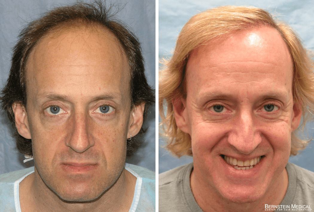 Bernstein Medical - Patient ECL Before and After Hair Transplant Photo 