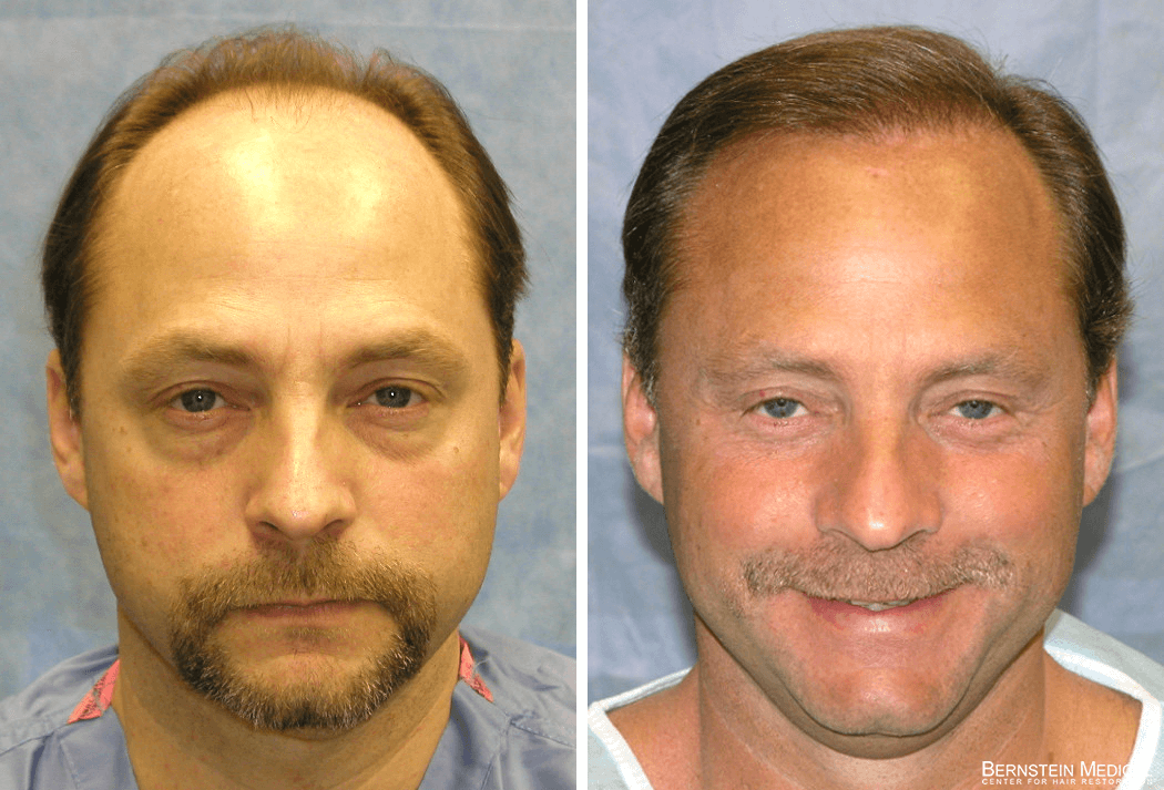 Bernstein Medical - Patient EJA Before and After Hair Transplant Photo 