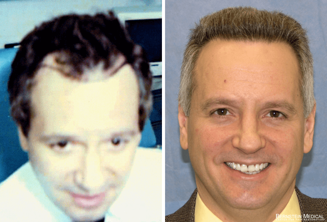 Bernstein Medical - Patient EOQ Before and After Hair Transplant Photo 