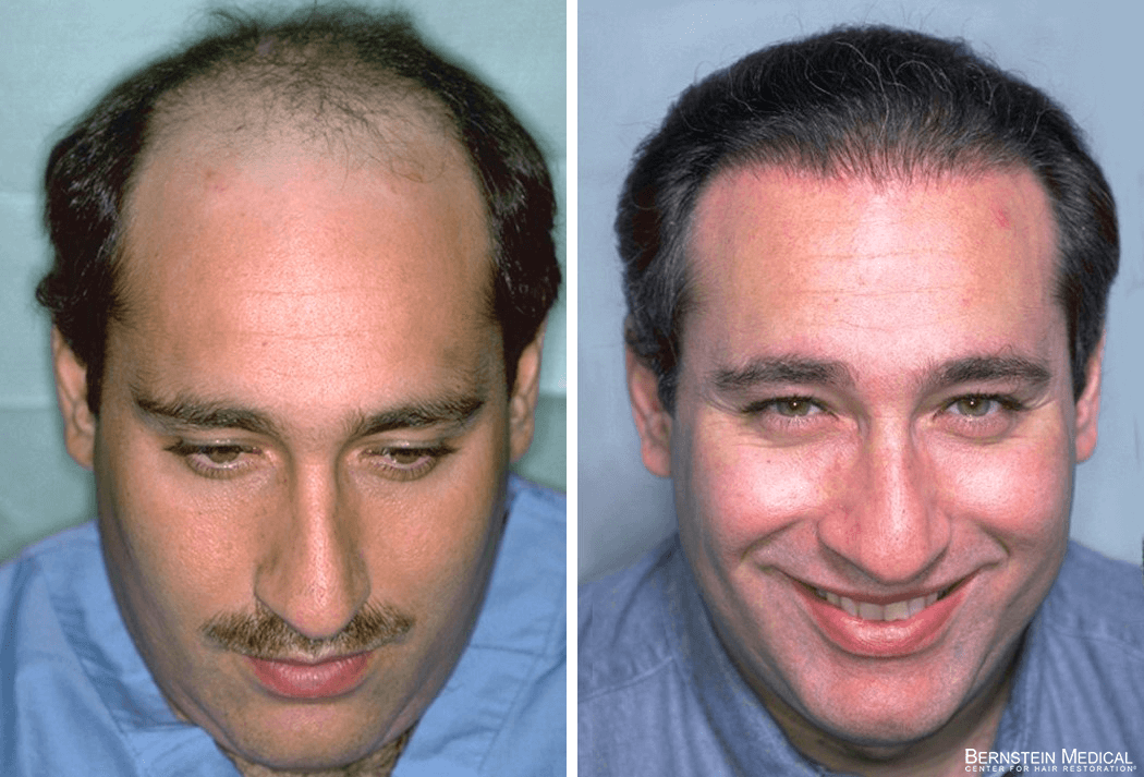 Bernstein Medical - Patient EQB Before and After Hair Transplant Photo 