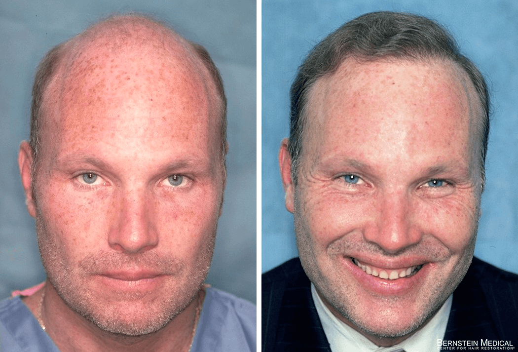 Bernstein Medical - Patient ERJ Before and After Hair Transplant Photo 
