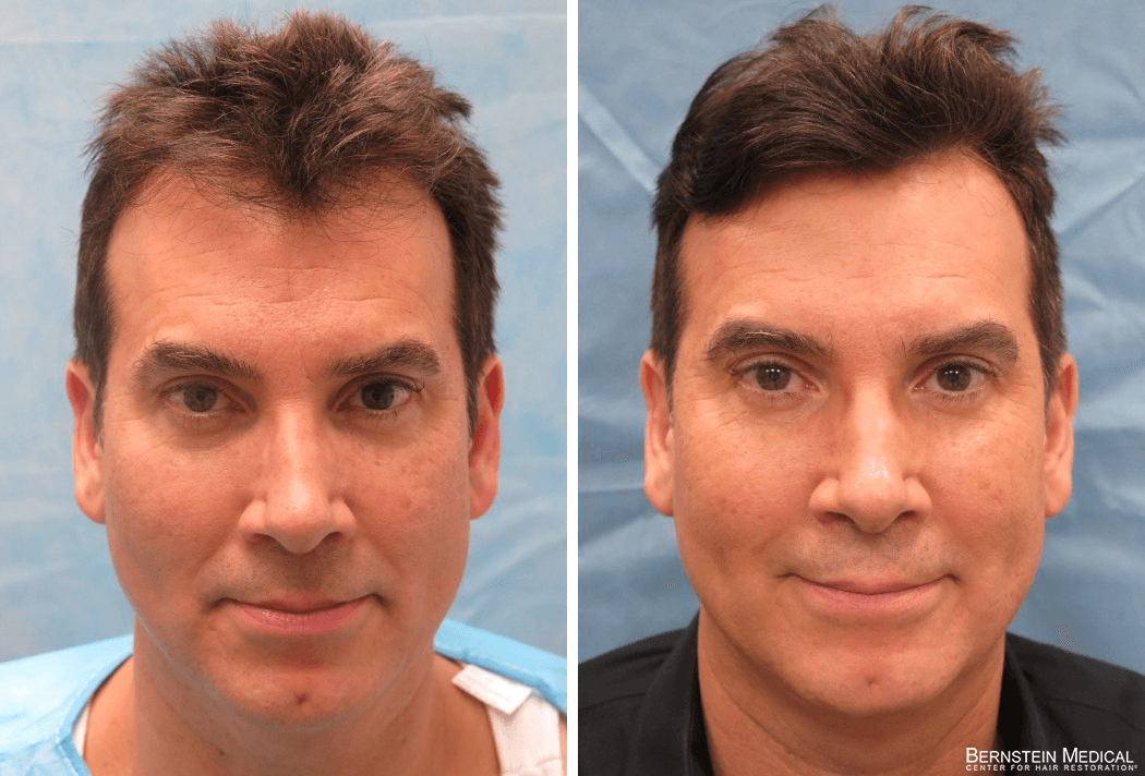 Bernstein Medical - Patient ESR Before and After Hair Transplant Photo 